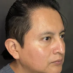 Resultados rinoplastia S Quito6