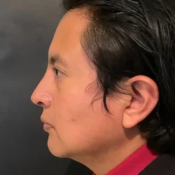 Resultados rinoplastia S Quito7