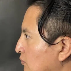 Resultados rinoplastia S Quito8