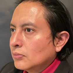 Resultados rinoplastia S Quito9