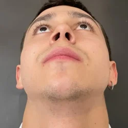 Resultados rinoplastia T Quito11
