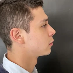 Resultados rinoplastia T Quito17