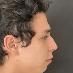 Resultados rinoplastia T Quito18
