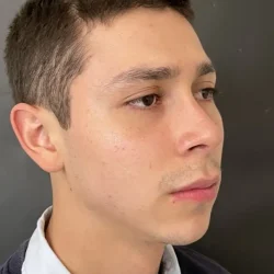 Resultados rinoplastia T Quito19
