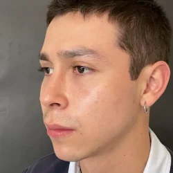 Resultados rinoplastia T Quito9