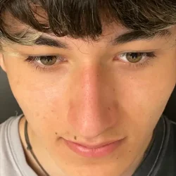Resultados rinoplastia U Quito13