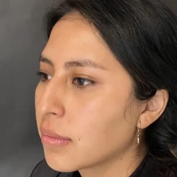 Resultados rinoplastia V Quito10