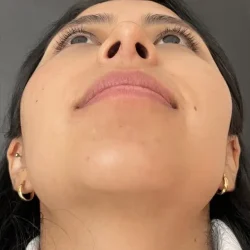Resultados rinoplastia V Quito11