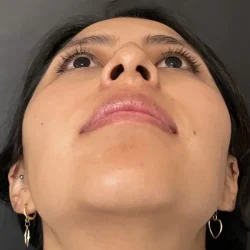 Resultados rinoplastia V Quito12
