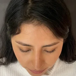 Resultados rinoplastia V Quito13