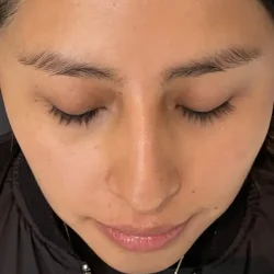 Resultados rinoplastia V Quito14