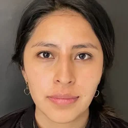 Resultados rinoplastia V Quito2