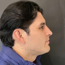 Resultados rinoplastia V Quito3