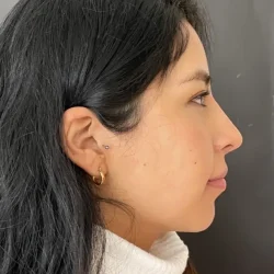 Resultados rinoplastia V Quito3