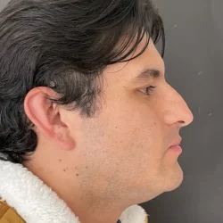 Resultados rinoplastia V Quito4