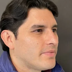 Resultados rinoplastia V Quito5