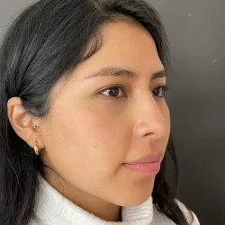 Resultados rinoplastia V Quito5