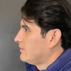 Resultados rinoplastia V Quito6