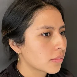 Resultados rinoplastia V Quito6