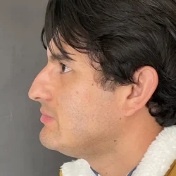 Resultados rinoplastia V Quito7