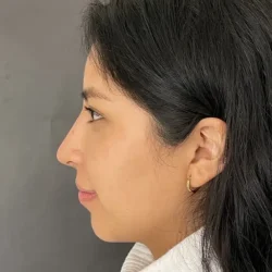 Resultados rinoplastia V Quito7