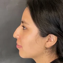 Resultados rinoplastia V Quito8