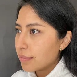Resultados rinoplastia V Quito9