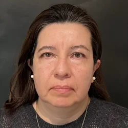 Resultados rinoplastia Y Quito1