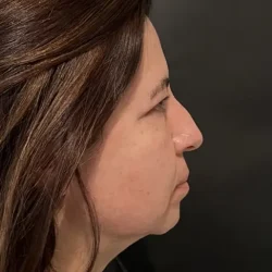 Resultados rinoplastia Y Quito2