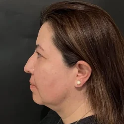 Resultados rinoplastia Y Quito4