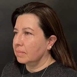Resultados rinoplastia Y Quito5