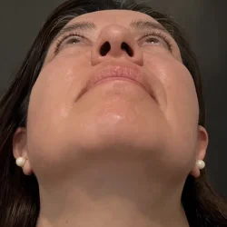 Resultados rinoplastia Y Quito6