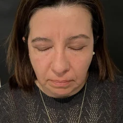 Resultados rinoplastia Y Quito7
