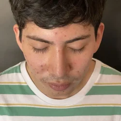 Resultados rinoplastia Z Quito13