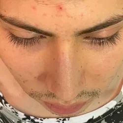 Resultados rinoplastia Z Quito14