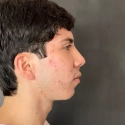 Resultados rinoplastia Z Quito3
