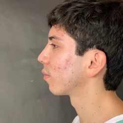 Resultados rinoplastia Z Quito7
